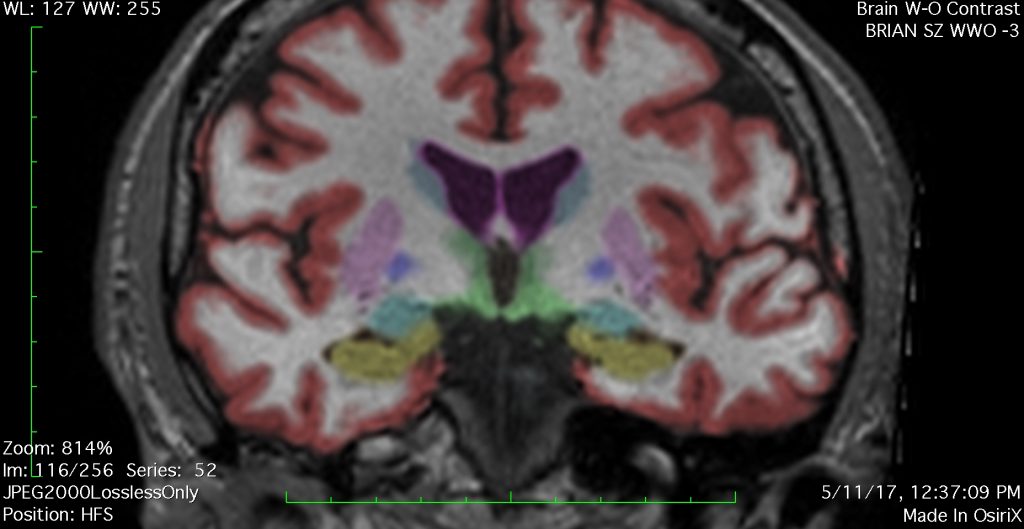 MRI in Carbon Monoxide Diagnosis